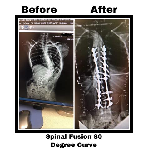 What happens if you accidentally bend after spinal fusion? - Health Blog