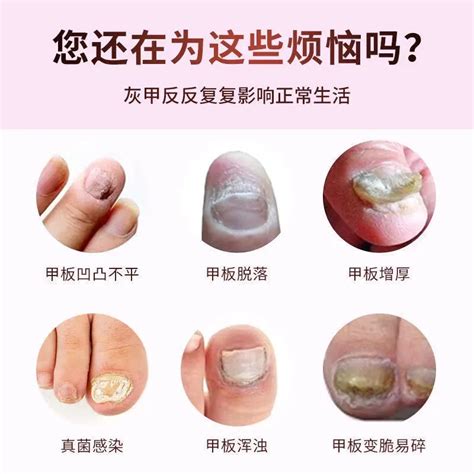 Share 137+ miconazole nitrate for nail fungus super hot - ceg.edu.vn