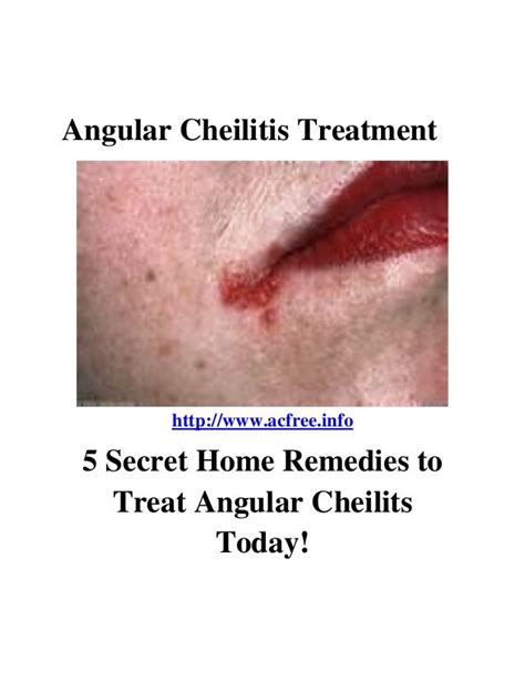 Angular cheilitis treatment 5 home recipes