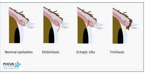 Focus Referrals | Eyelash disorders