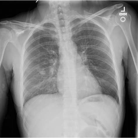 Initial chest xray image with mild right perihilar infiltrate and right... | Download Scientific ...