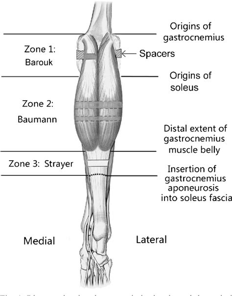 Comparison of the efficacy of three isolated gastrocnemius recession procedures in a cadaveric ...