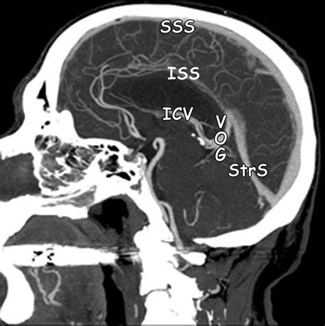 Cerebral Venous Thrombosis and Multidetector CT Angiography: Tips and Tricks | RadioGraphics