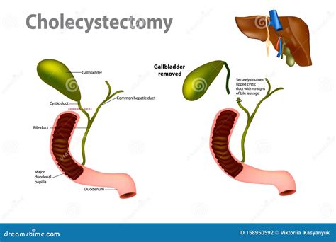 Gallbladder Removal Surgery Stock Vector - Illustration of operation, removal: 158950592