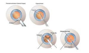 Phaco Surgery | Types Of Cataract Surgery | Phacoemulsification