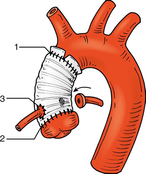 Postoperative Echocardiography of the Aorta - Clinical Tree