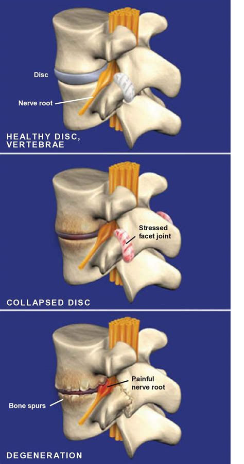 Spondylosis Show Low AZ | Spondylosis Treatment