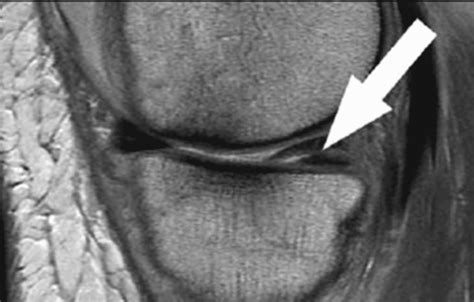 Cureus | Meniscus Tear: Pathology, Incidence, and Management