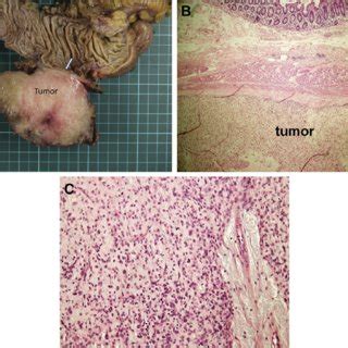 e (A) The gross specimen showed an exophytic tumor arising beneath the ...