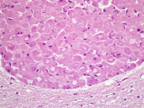 Granular Cell Tumor Histology