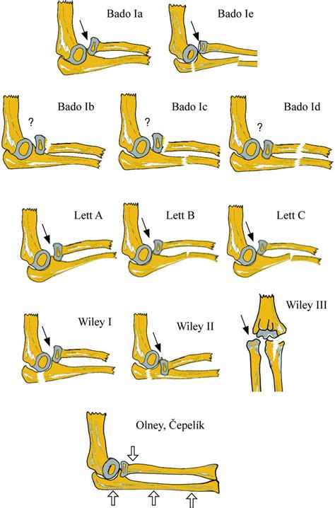 Monteggia equivalent lesion in children: a narrative review | World Journal of Pediatric Surgery