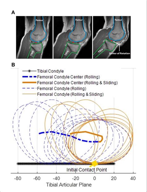 FIGURE E (A) Magnetic resonance imaging (MRI) scanned for human knee ...