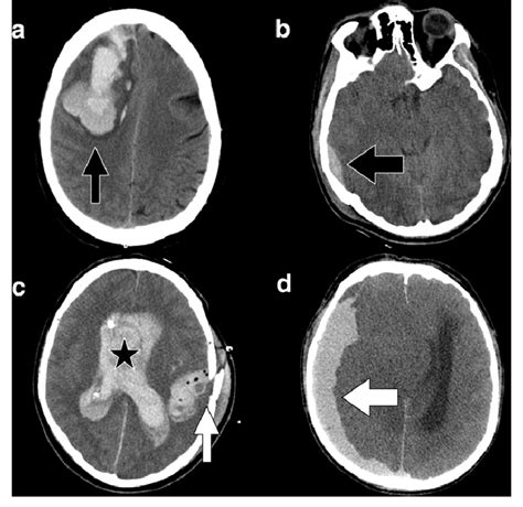 Intracranial Hemorrhage Ct Scan Ct Scan Machine Images | The Best Porn Website