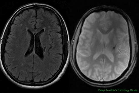 Dr Balaji Anvekar's Neuroradiology Cases: Wallerian degeneration MRI Brain