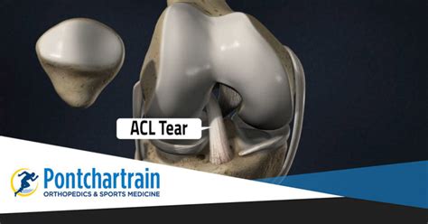 ACL Tear - Pontchartrain Orthopedics & Sports Medicine