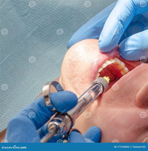 Doctor Gives Anesthetic Injection To Patient in Dental Clinic Stock Photo - Image of doctor ...