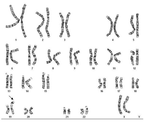 GTG-banded karyogram of the proposita showing an abnormal chromosome 19. | Download Scientific ...