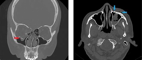 a, b. Coronal CT scan shows blow-out fracture on the right side (red ...