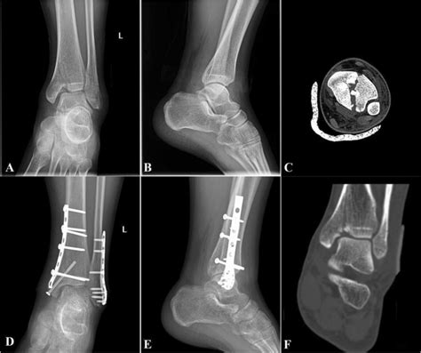 A and B show the “horizontal” fracture line of the lateral malleolus ...