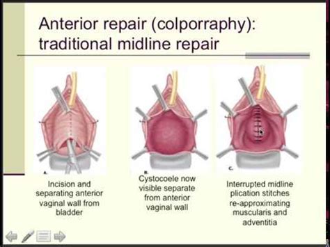 DAROGA Pelvic Organ Prolapse Part Two [MESH REMOVED FROM MARKET NOV 17 ...