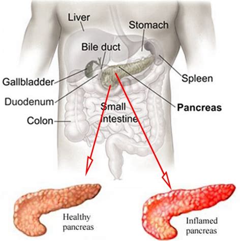 What Is Acute Pancreatitis & What Happens In Acute Pancreatitis?LPC