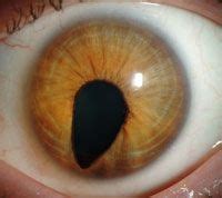 22 Colobomas ideas | eyes, human oddities, eye health