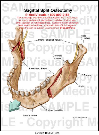 Medivisuals Sagittal Split Osteotomy Medical Illustration