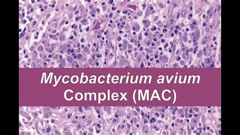 Mycobacterium avium complex; Battey Bacillus; MAIC; Mycobacterium avium-intracellulare ...