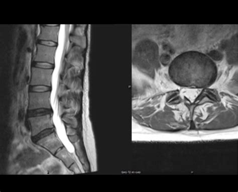 Lumbar Spine Herniated Disc Exercises at Robt Shannon blog