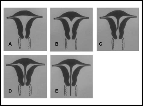 Can uterine septum cause miscarriages?