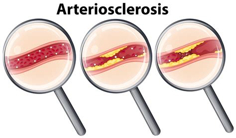 Umbria Arteriosclerosis