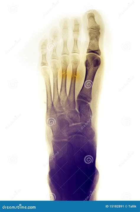 Foot X-ray Showing Fractures Stock Image - Image of injured, human ...