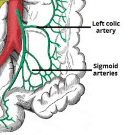 Consent: Hartmann’s Procedure - TeachMeSurgery