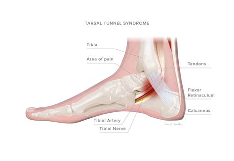 Tarsal Tunnel Syndrome – KevinRoot Medical