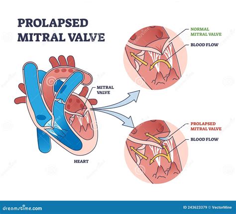 Prolapsed Mitral Valve Heart Disease Comparison With Normal Outline Diagram Cartoon Vector ...