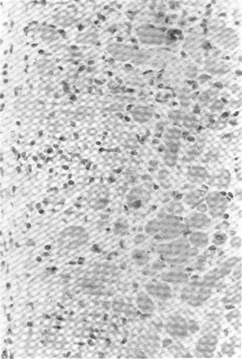 Figure 1 from The results of transvenous endomyocardial biopsy can frequently be used to ...