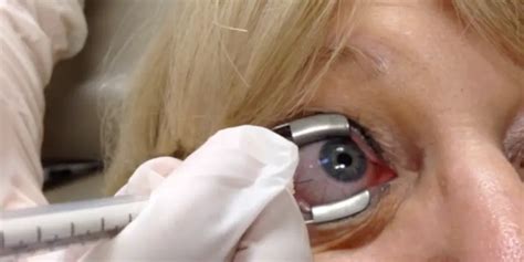 Intravitreal Injection Procedure - American Academy of Ophthalmology