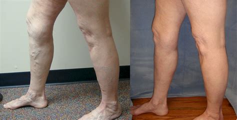 Varicose Veins - Vein Specialists of the Carolinas