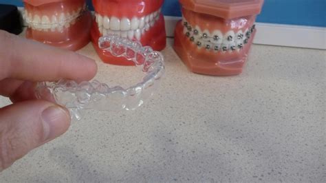 A Dozen Dos and Don'ts - 12 Tips for successful orthodontic retainer ...