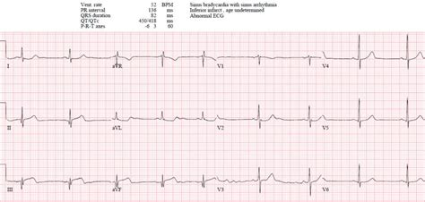 ECG Cases 14: Q-waves and Occlusion MI | EM Cases