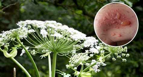 Giant hogweed: How to identify plant that causes burns and blisters