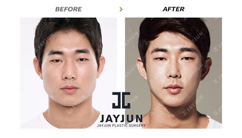 Korean Skin Botox Before And After | Before And After