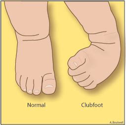 Fetal Clubfoot | Lurie Children's