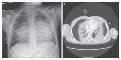 Blast Injuries - RCEMLearning