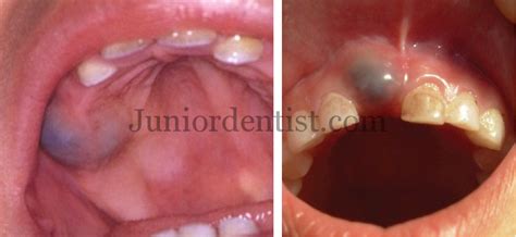 Eruption Cyst or Hematoma Clinical Features, Diagnosis and Treatment