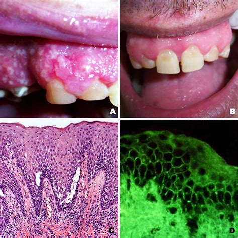 Oral pemphigus vegetans: A case report