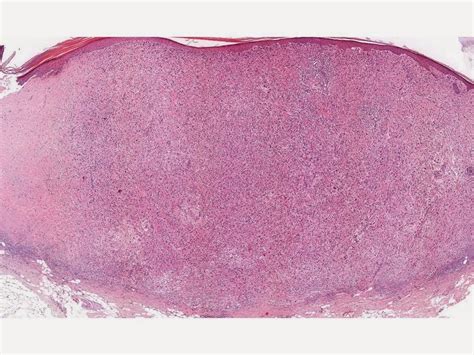 Dermpath Made Simple - Neoplastic: Atypical Fibroxanthoma