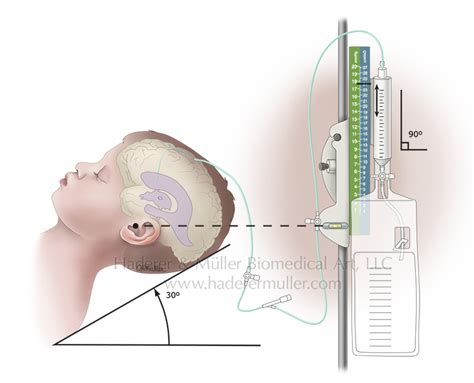 External ventricular drain | HADERER & MULLER