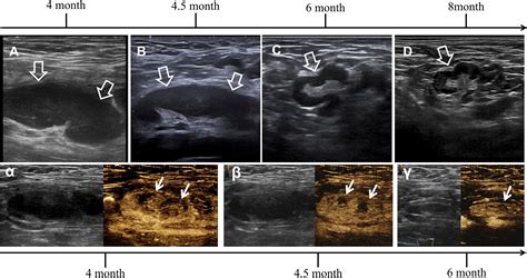 Frontiers | Misdiagnosis of Reactive Lymphadenopathy Remotely After ...