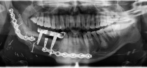 Ameloblastoom chirurgie / Hoe behandelt u Ameloblastoom? | Tanger